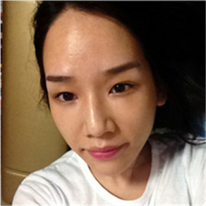 北京南加高紅霞醫(yī)生做的頭發(fā)種植，恢復得很好~